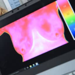 Nog steeds aanbieders van dubieuze screeningmethode voor borstkanker actief